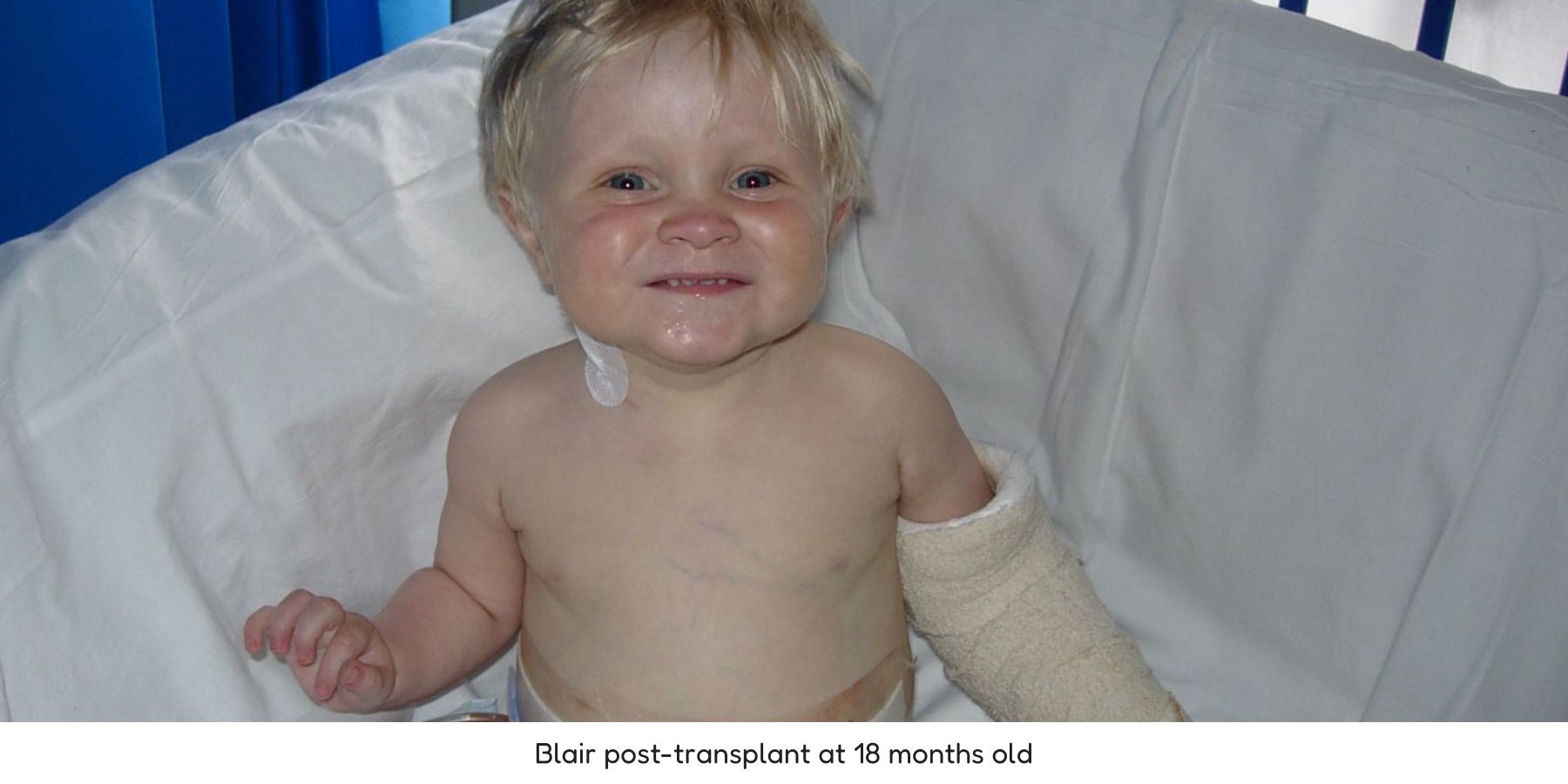 Blair post-transplant at 18 months old